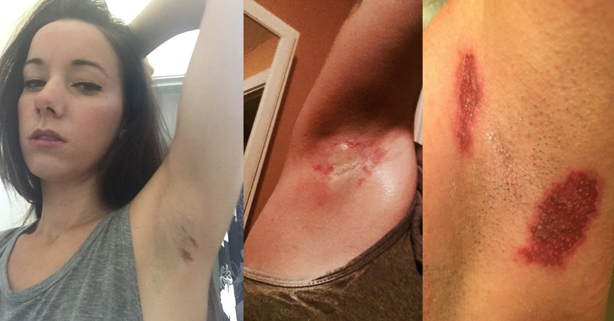 Have you been burned by old spice? Deodorant is still being sued for causing chemical burns