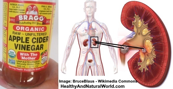 apple cider vinegar uses for kidney stones