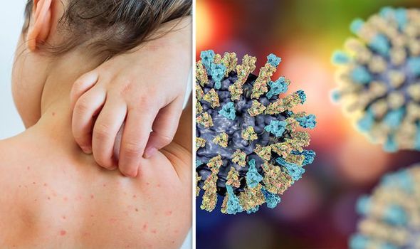 MEASLES OUTBREAK: 100,000 sick as cases hit ‘alarming level’ - WHO warning