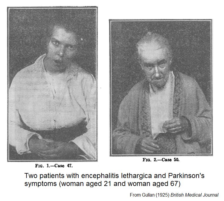 Encephalitis lethargica: the unexplained epidemic that made people to sleep for decades