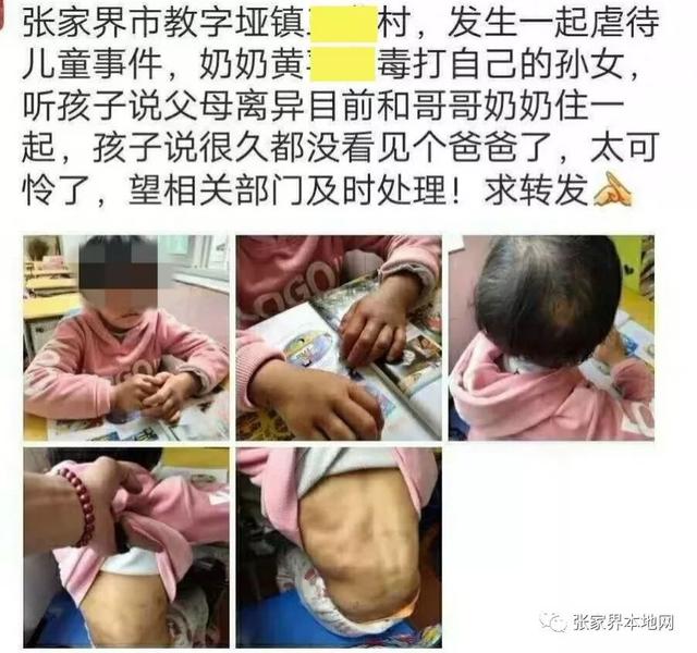 心太狠了！9岁女童遭奶奶暴打，全身多处淤青，头发被揪掉...