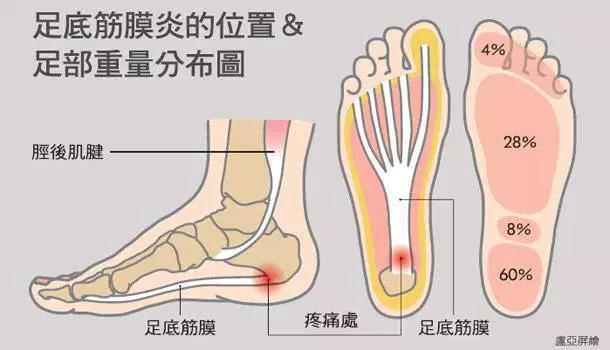 一下床踩地就脚痛？小心「足底筋膜炎」教你3招一生受用