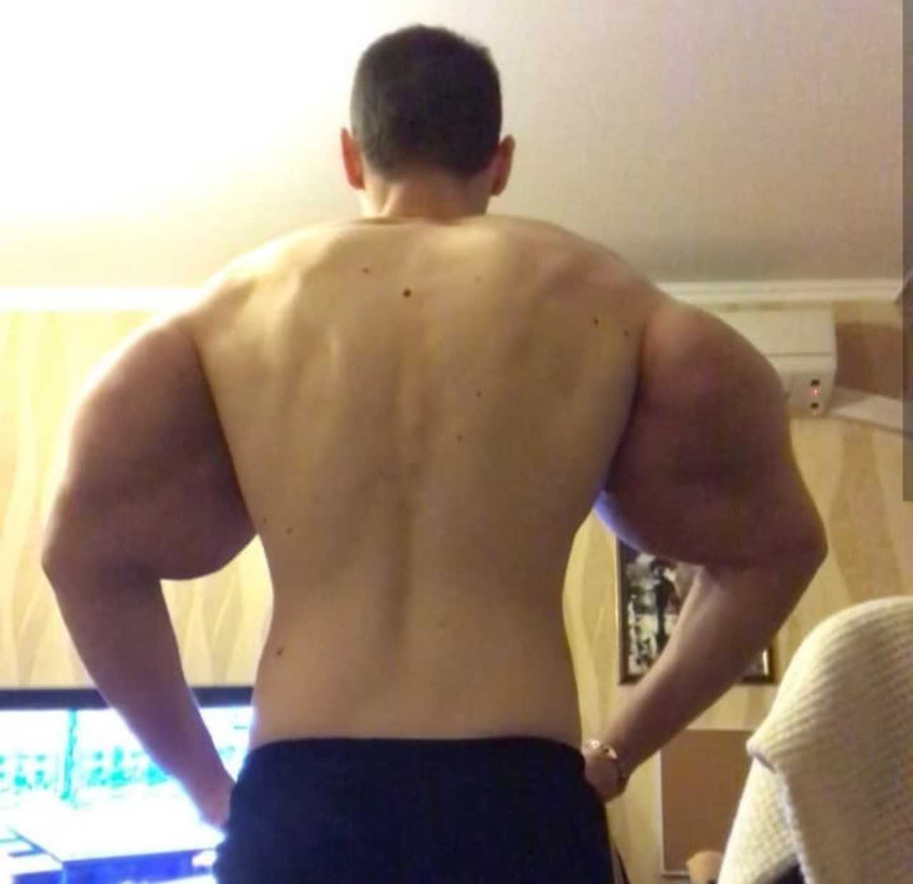 'Popeye' Bodybuilder Raising Money For UK Operation To Save His Arms