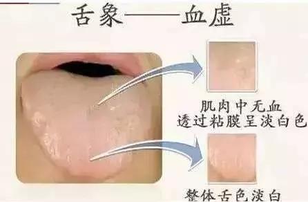 舌头是人体健康的“放大镜”，几种常见舌象的解决办法