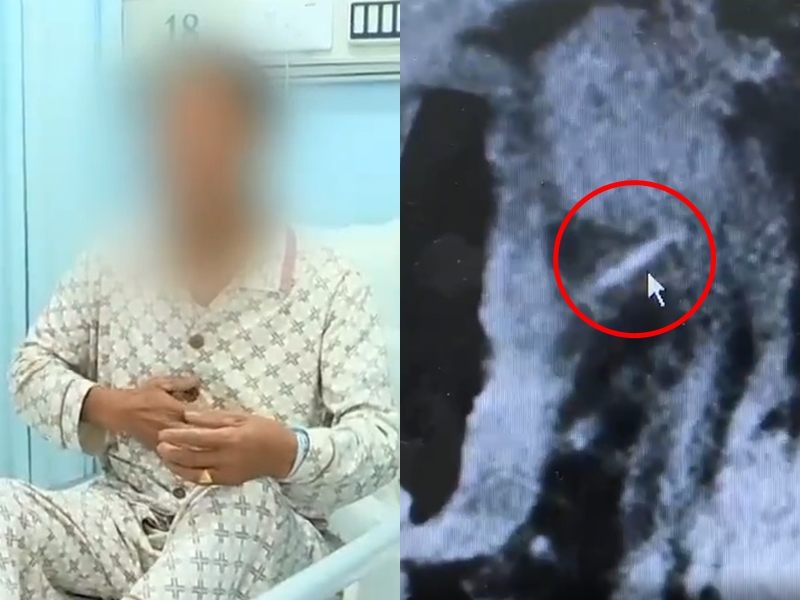 湖南69岁老翁误吞牙籤 一星期后腹部剧痛就医发现胃壁被刺穿