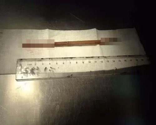 岁半B女边食饭边玩 不慎跌倒筷子刺穿脑部