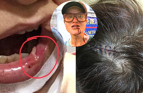 Celine Ma Gets 11 Stitches After Attack