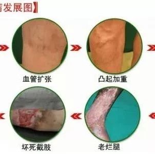 下肢静脉曲张的康复治疗
