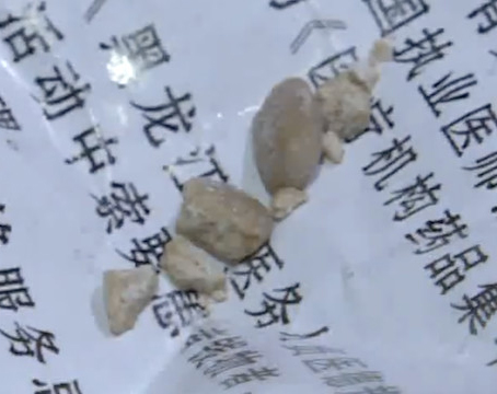 钙质补过量 2岁男童罹患肾结石
