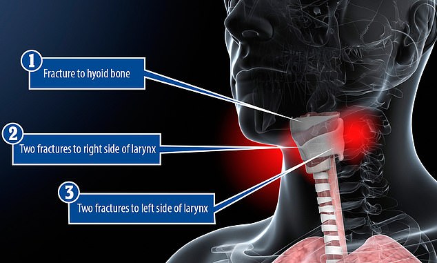 Jeffrey Epstein's autopsy report summary is released with pictures showing his two neck fractures after pathologist claims the millionaire pedophile's body bore signs of homicide by strangulation NOT suicide