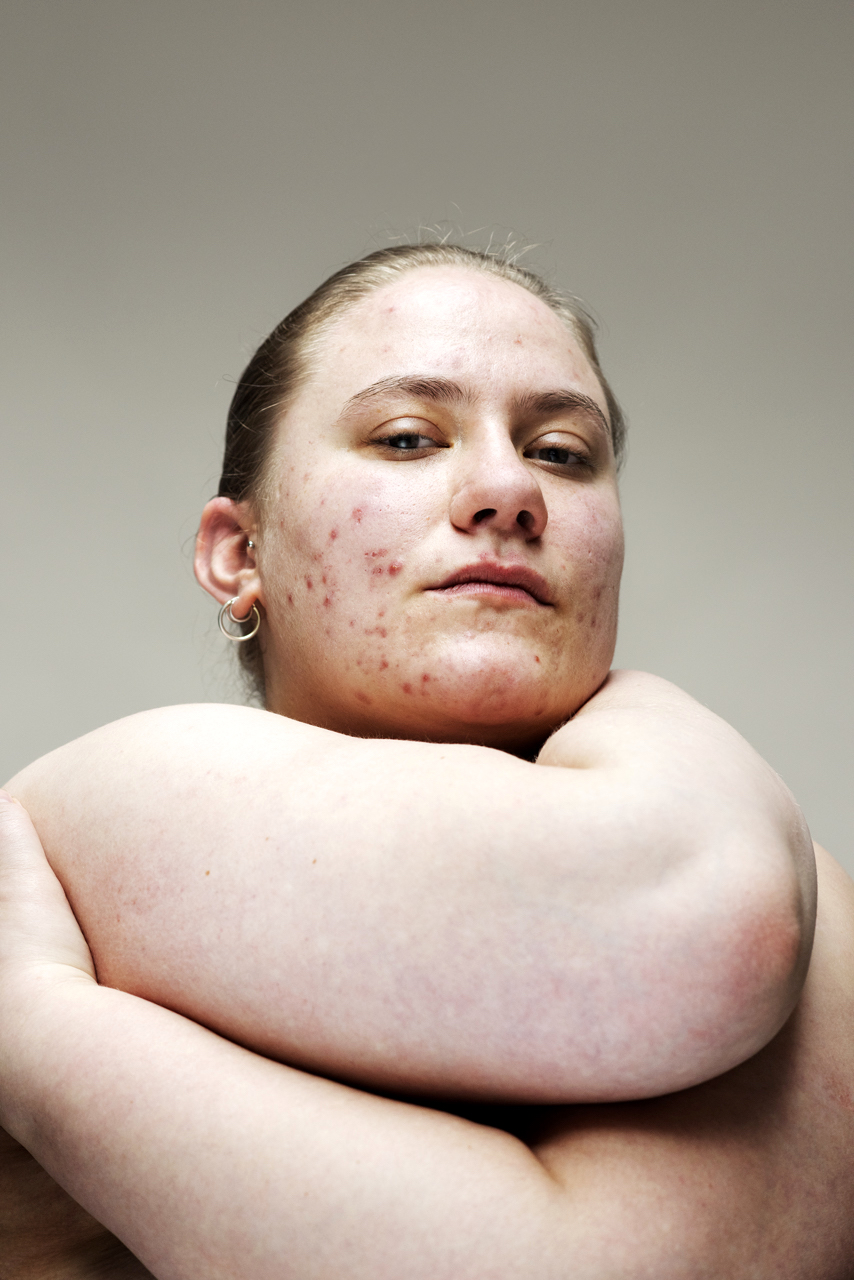 Makeup-free portraits of women with acne, eczema, and rosacea will change the way you look at your skin