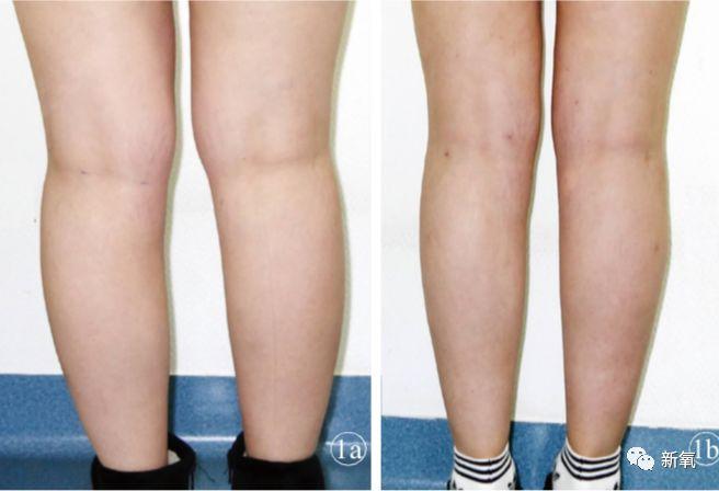 又一年轻女孩在吸脂时意外死亡，“脂肪大战”行业内幕终被揭开了