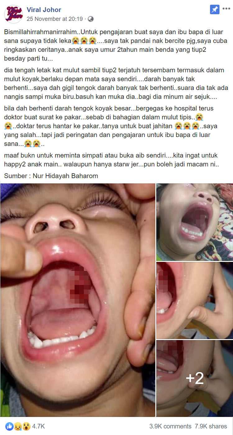 Party horn pokes roof of Boy’s mouth till it tears & bleeds, mum warns parents to be careful