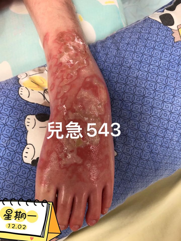【健康Talk】敷暖水袋保暖可致低温烫伤 3类高危族需注意