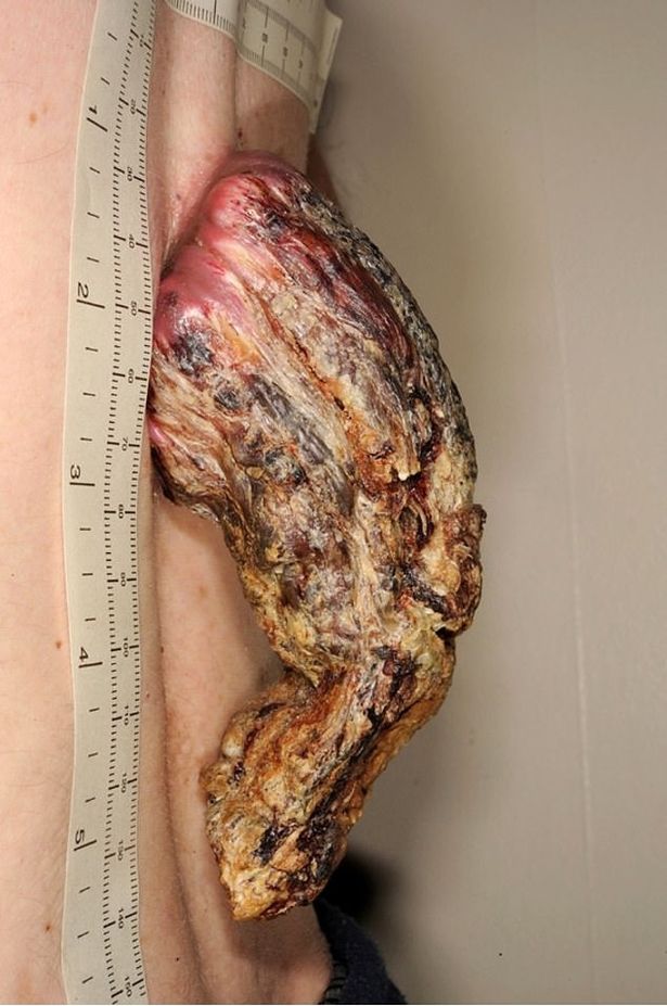Man has five-inch 'dragon horn' skin cancer removed after ignoring it for three years