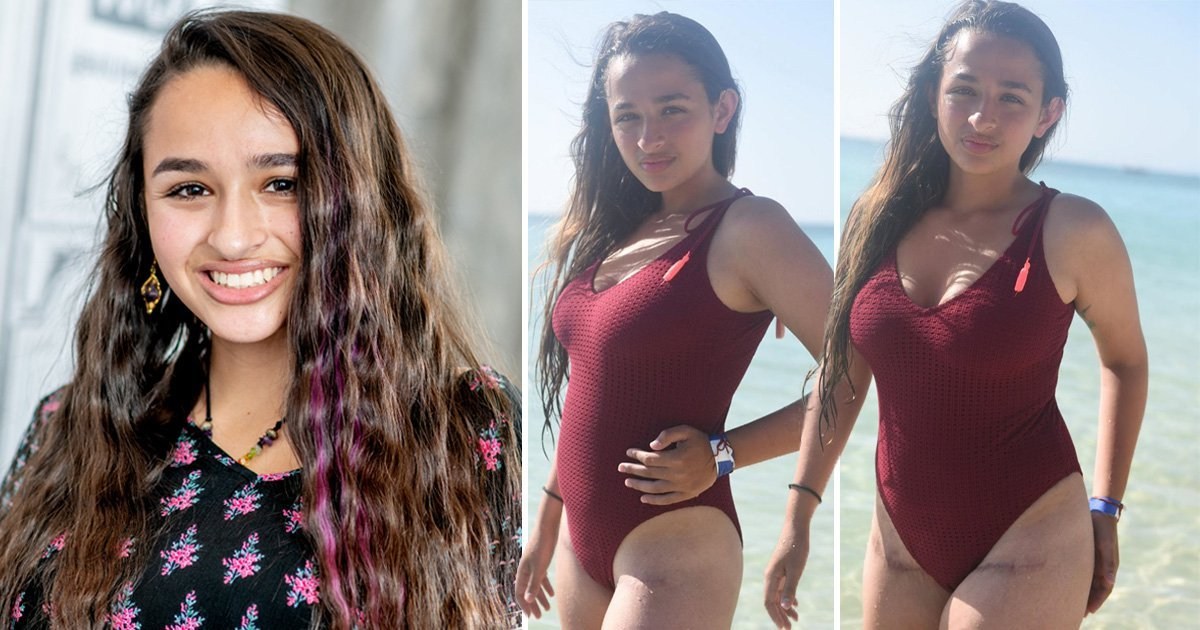 Transgender teen Jazz Jennings proudly shows off ‘battle wound’ scars after gender confirmation surgery