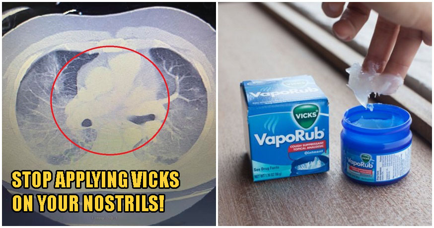 Applying Vicks On Your Nostrils Can Lead To Respiratory Complications, Says Doctor