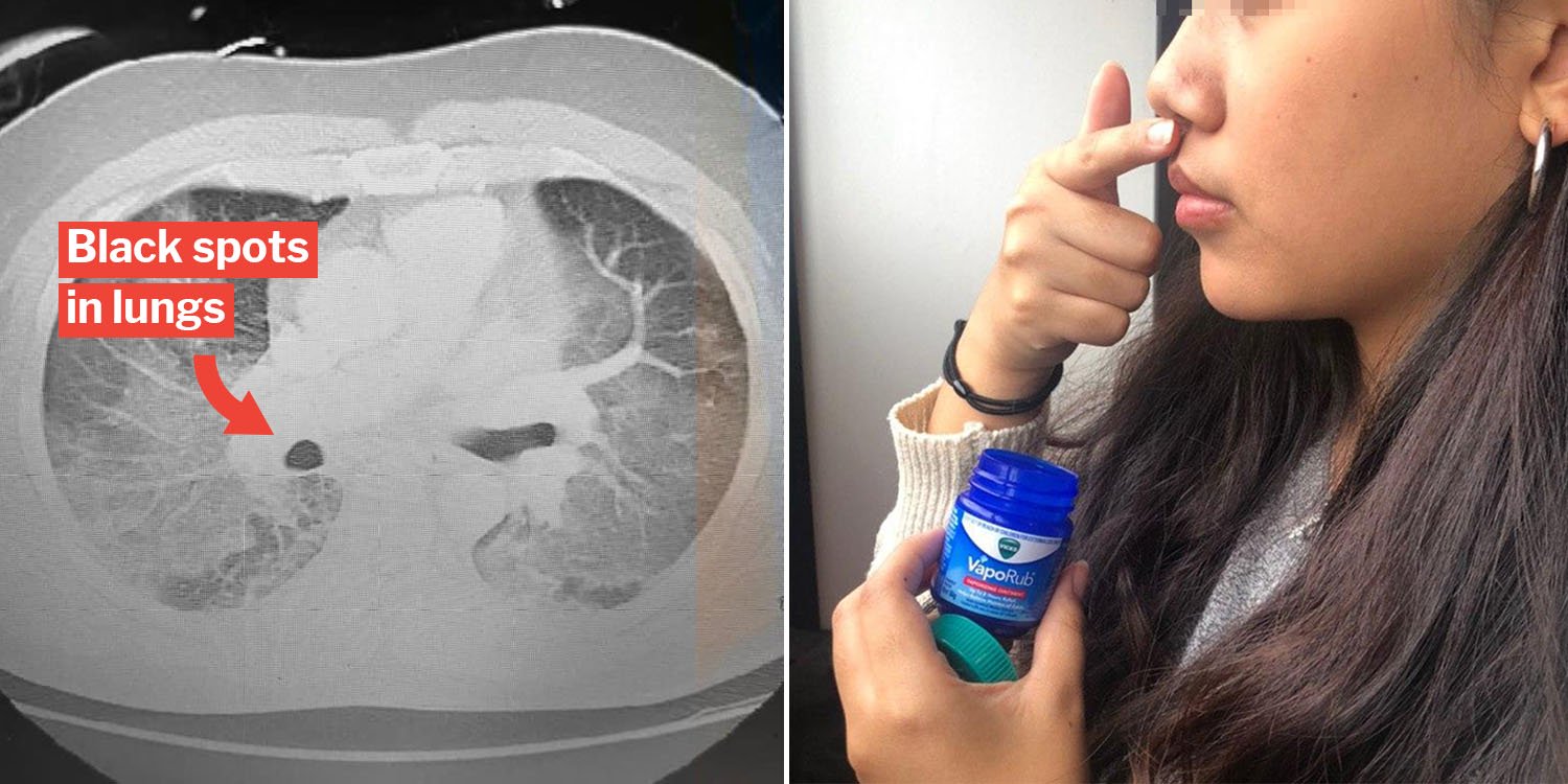 Applying vicks vaporub under your nose May cause pneumonia, claims US doctor