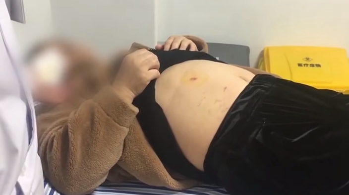 恐怖！江西妇鲠鱼骨刺穿胃壁 8年间体内游走