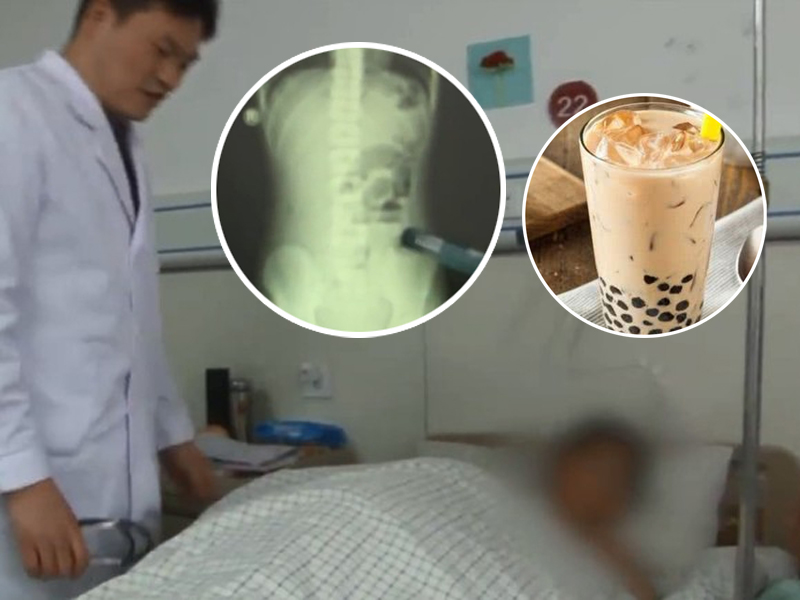 少年喝珍珠奶茶不咀嚼 一周吞两杯肠梗塞腹痛入院