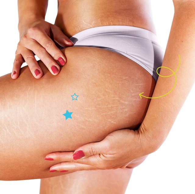 9 Best Stretch Mark Creams for Removal and Prevention