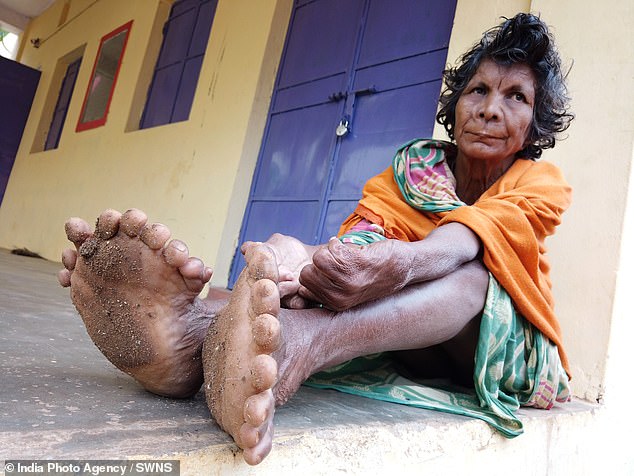 Thumb-believable! Indian woman with NINETEEN toes and 12 fingers sets new world record for number of digits