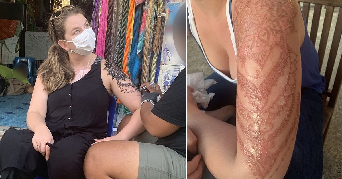 Woman left with massive scar after getting black henna tattoo on holiday