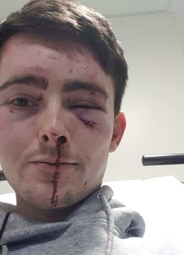 Man, 23, left with fractured eye socket after brutal attack by two thugs