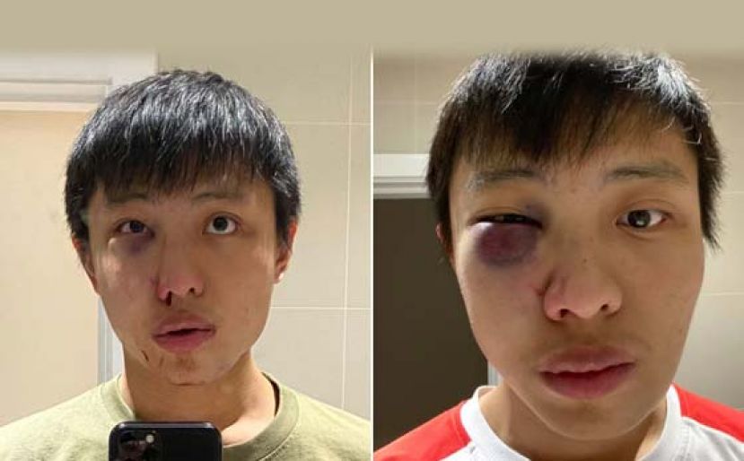 狮城少年疑因疫情受歧视 伦敦街头被围殴致重伤