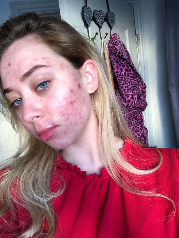 Beauty queen shares make-up free photos of her acne - and is stunned by the reaction