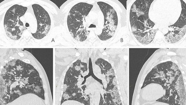 ct-scans-and-x-rays-display-the-damage-to-the-lungs-of-covid-19