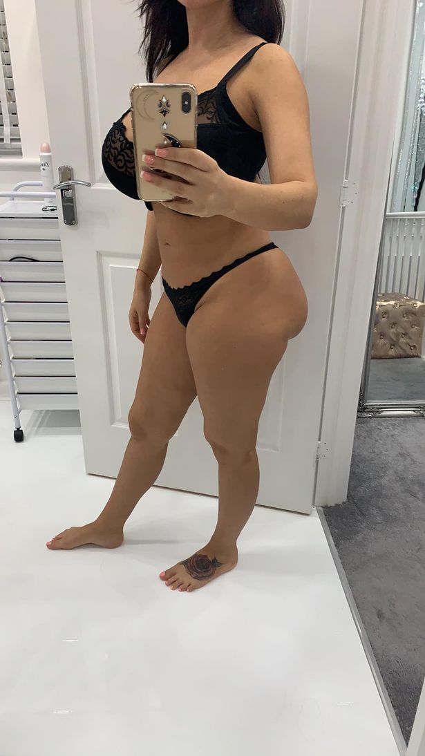 Botched bum implants leaves women looking like she's wearing a nappy