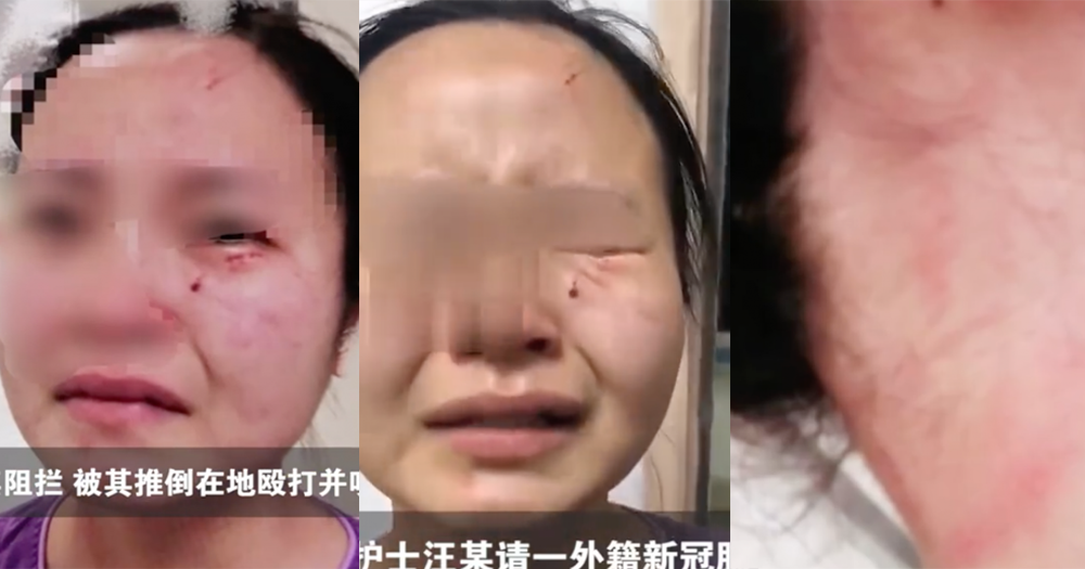 Covid-19 patient bites nurse’s face in Guangzhou, tries to escape hospital
