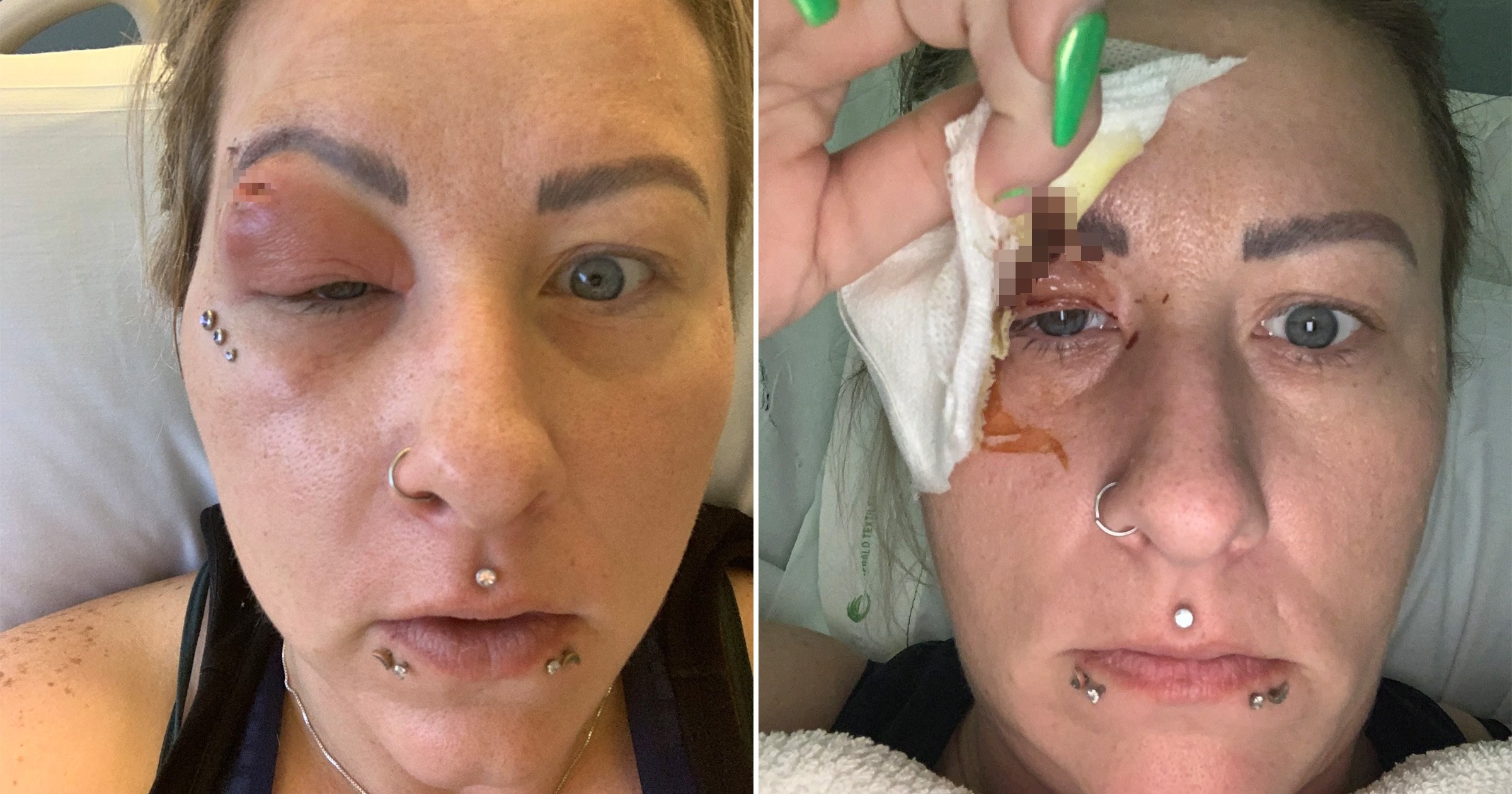 Hairdresser nearly lost her eye after hair splinter caused a serious infection
