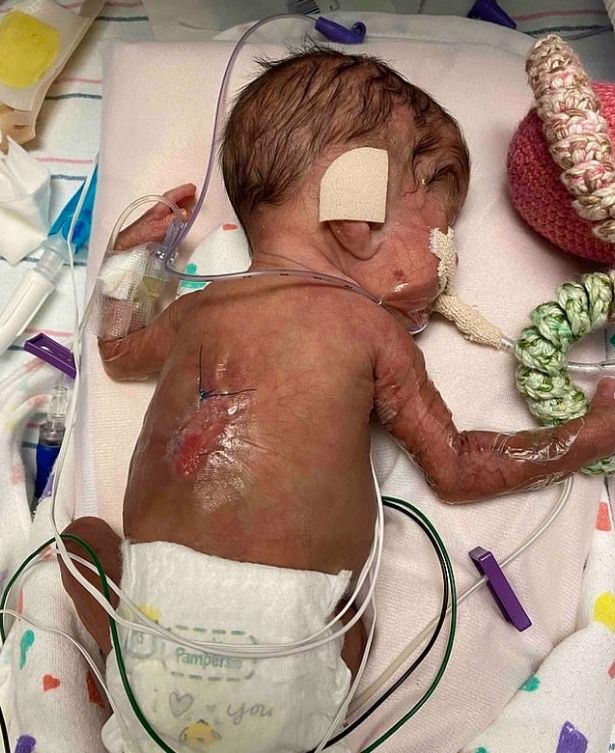 Astonishing photos show birth of second most premature twins babies ever to survive