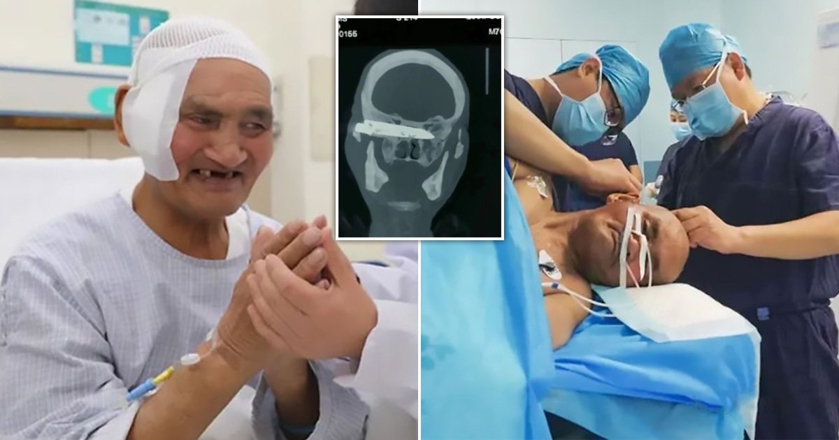 Rusty knife embedded in man’s head for 26 years after being mugged