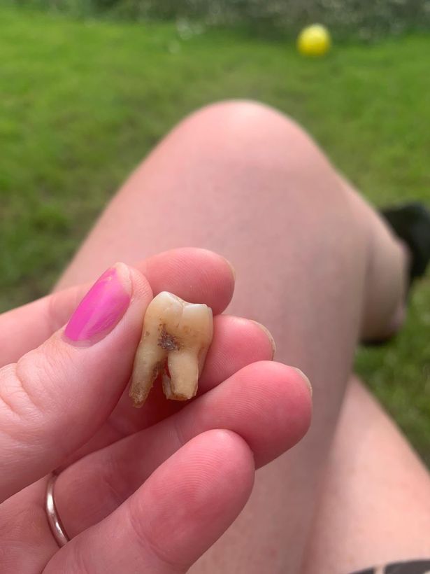 Mum drank 4 beers before pulling out own tooth after dentists closed in lockdown