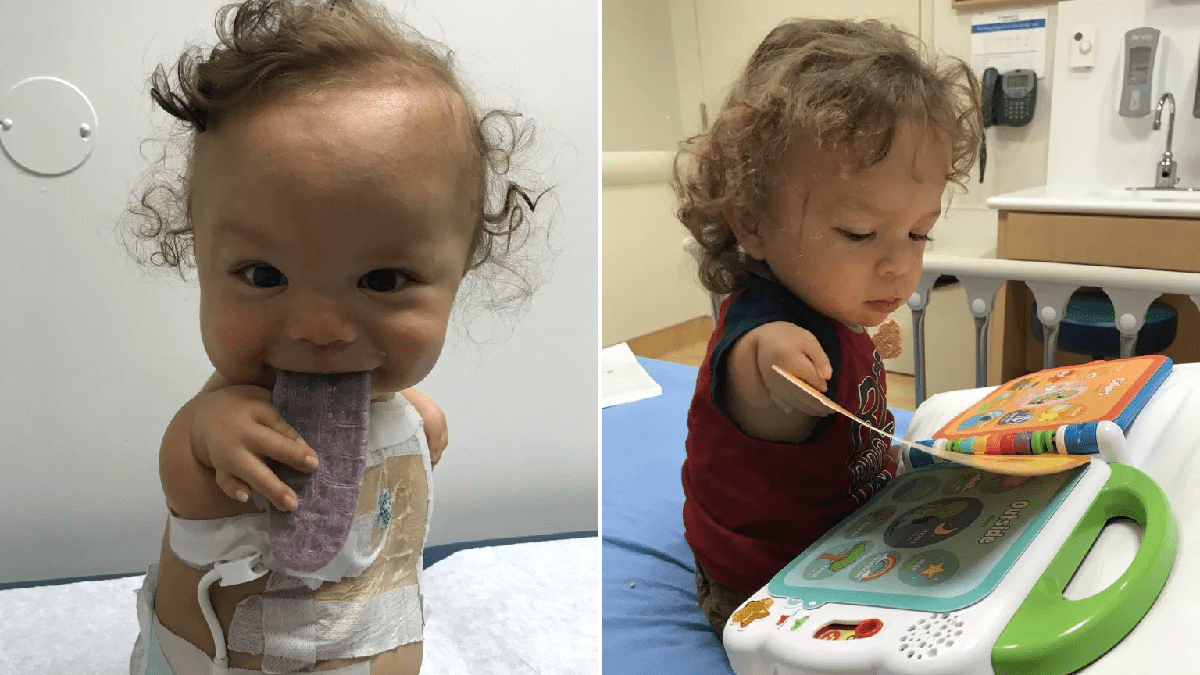 Toddler born with no arms or knees hopes to take his first steps after pioneering surgery