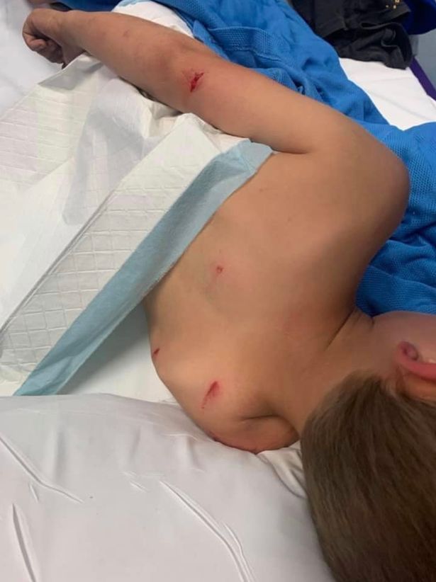 Autistic boy's horror injuries after he's attacked by kangaroo while protecting sister