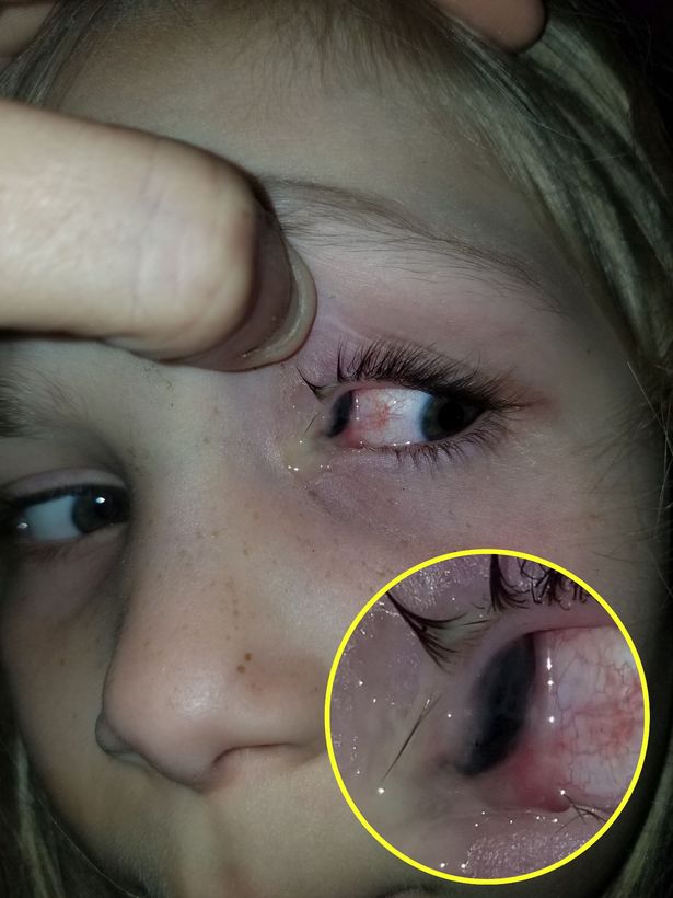 Mum shares stomach-churning photos after beetle crawls out from behind daughter's eye
