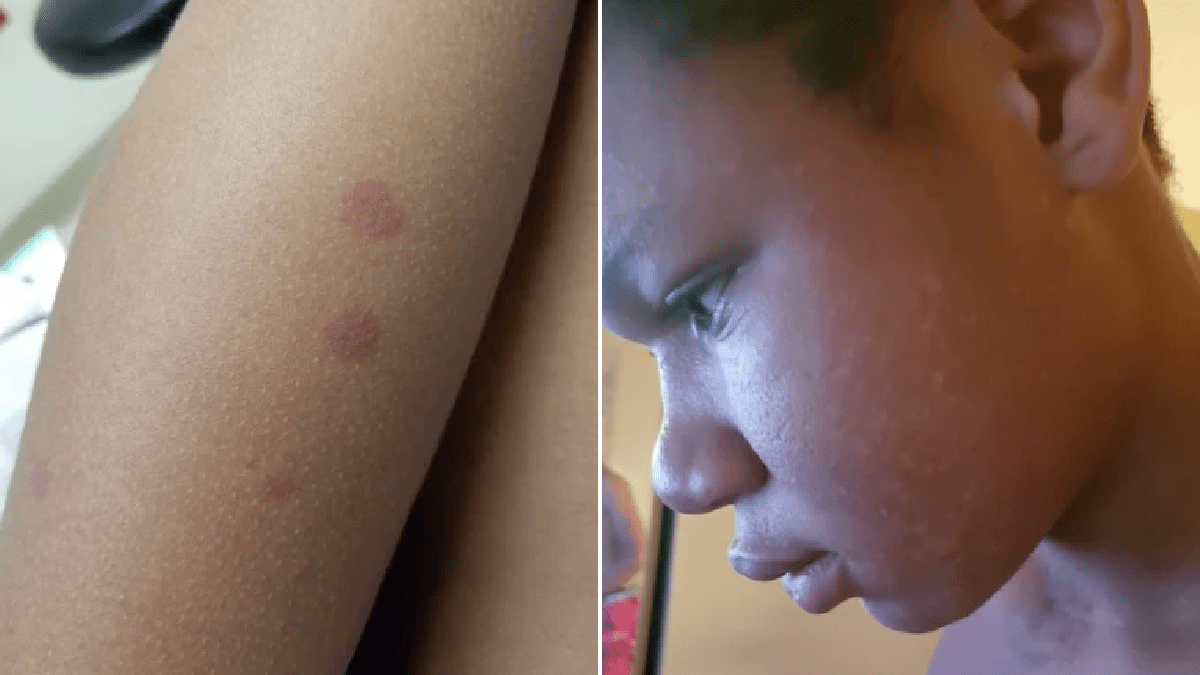Boy, 15, faces life-long stroke risk after getting ‘coronavirus-linked’ Kawasaki disease