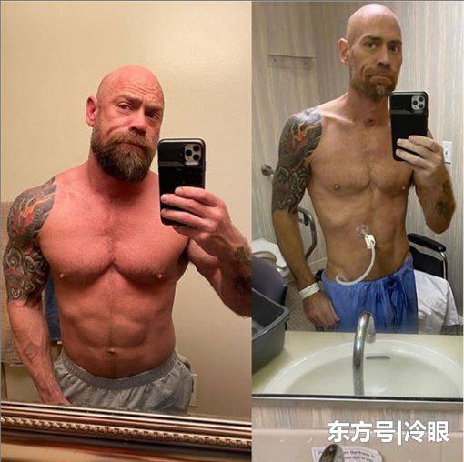 美肌肉男参加派对染疫，历经57天治疗后暴瘦23公斤