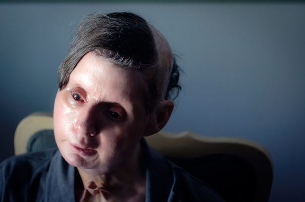 Horrifying injuries of woman who had face and hands ripped off by pet chimp - and survived