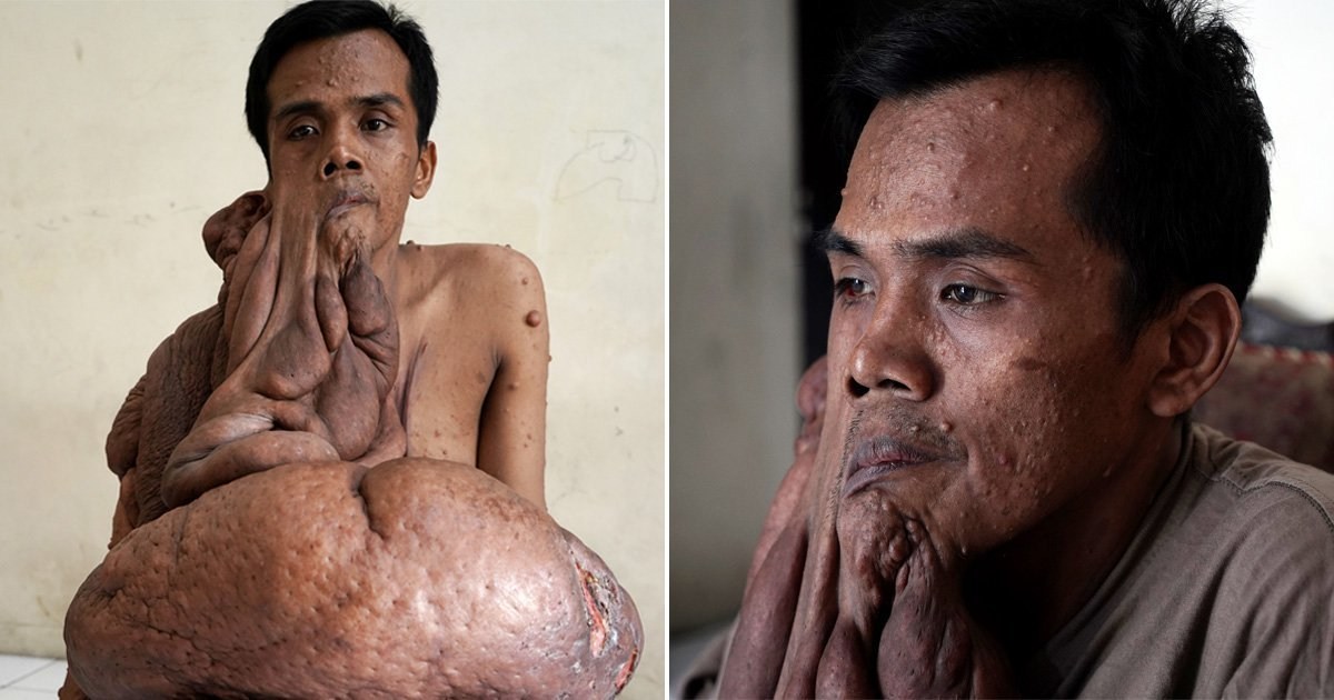 Man with 30kg of tumours on his body can’t afford to get rid of them