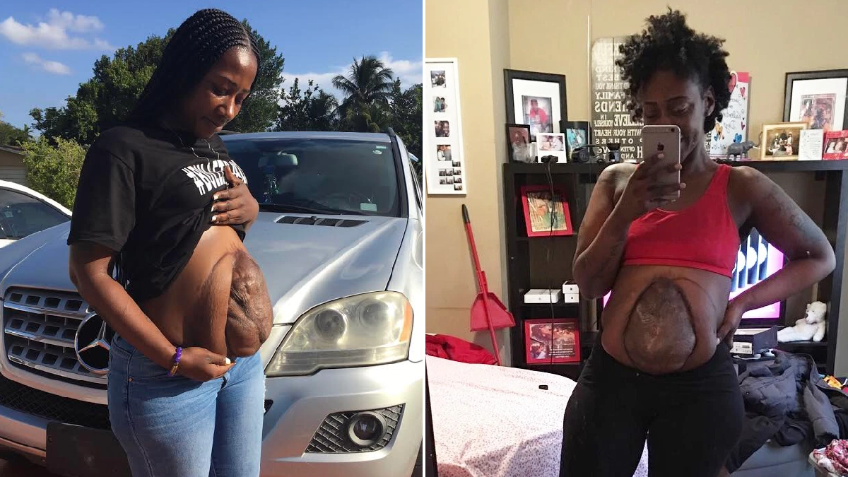 Mother forced to live with her intestines hanging out after horrific nightclub shooting