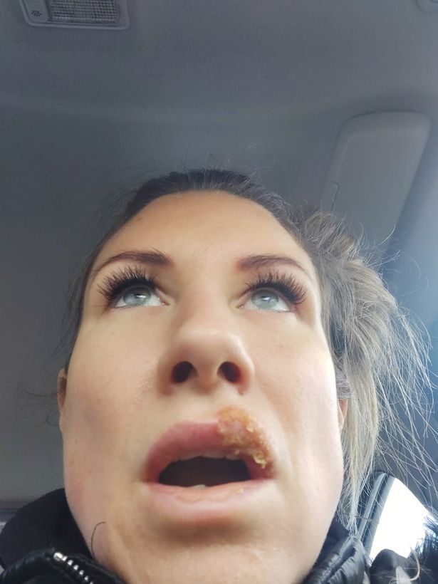 Mum's lips explode five times from £180 fillers as she sobs 'I regret them so much'