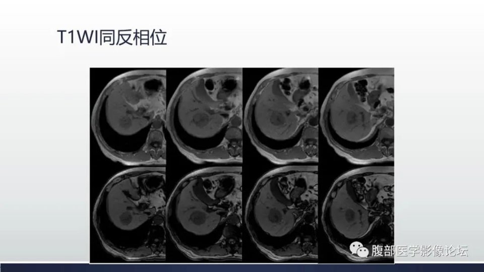 肝脏丨肝细胞肝癌案例分享