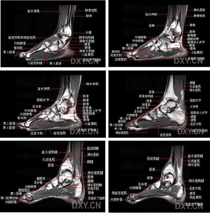 踝关节mri解剖及7种常见损伤类型 Nestia