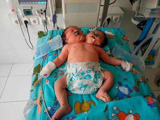 Tragic conjoined twins who had two hearts but shared one body die hours apart