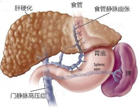 上海东方肝胆外科医院夏勇 肝硬化门脉高压症诊断治疗 Nestia